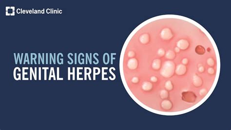 herpes in penus|Genital Herpes: Causes, Symptoms, Treatment & Prevention